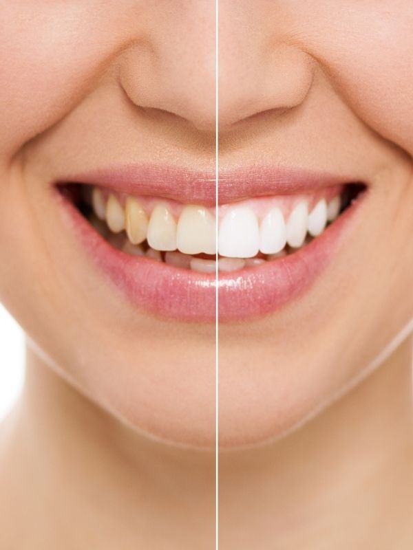 Winnipeg Teeth Whitening
